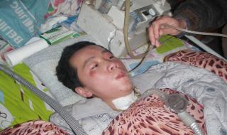 渐冻症一般能活多少年