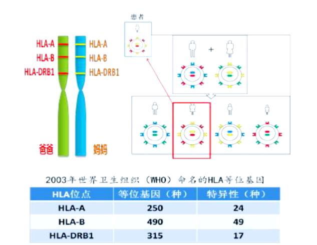器官移植的HLA配型关键点（hla 器官移植）