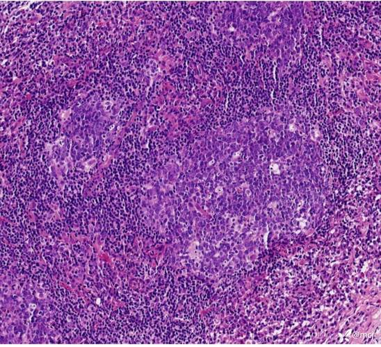 组织细胞坏死性淋巴结炎(组织细胞坏死性淋巴结炎是什么病)